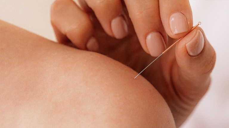 what-happens-when-dry-needling-hits-nerve