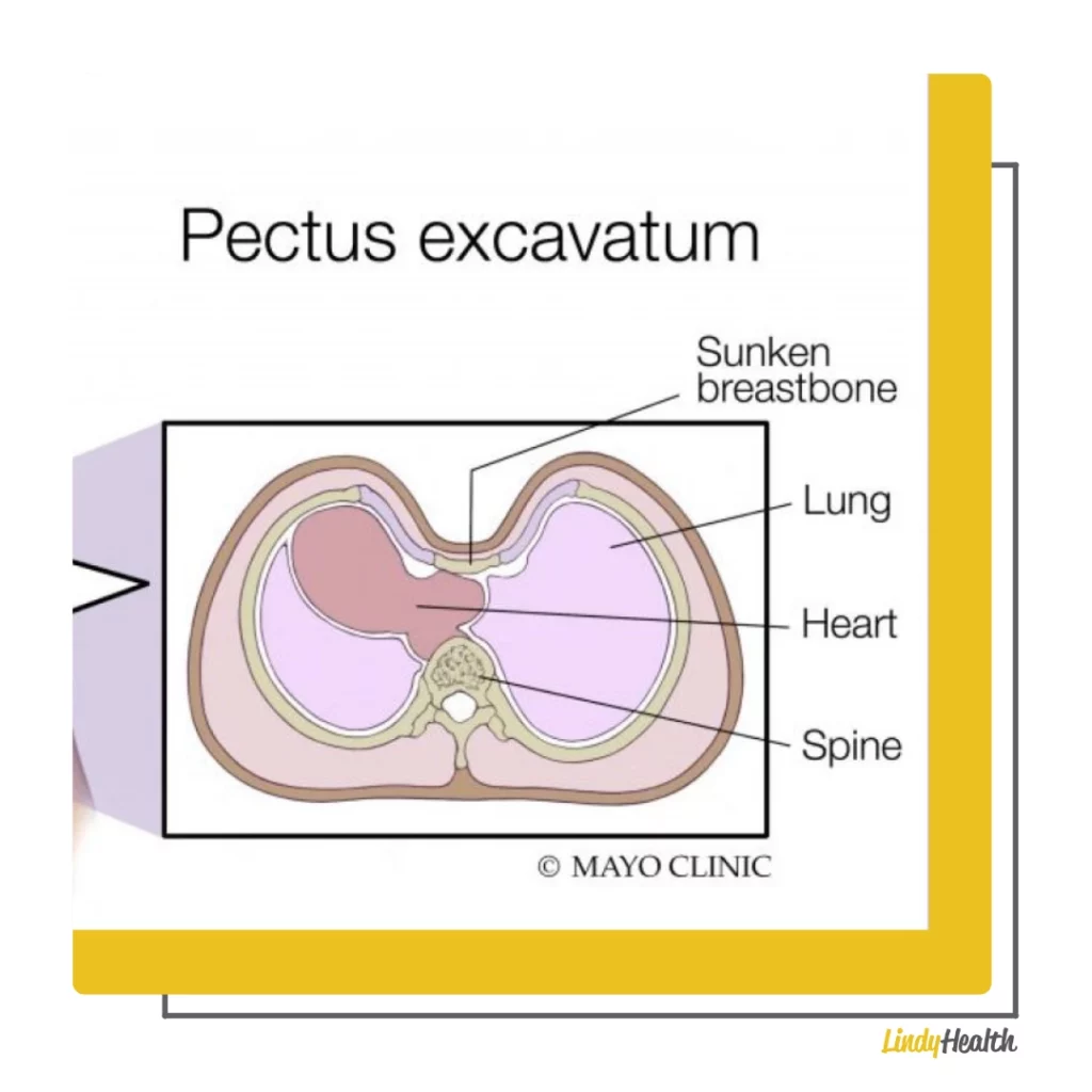pectus excavatum athletes