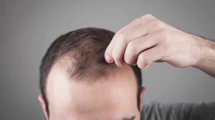 Steroids that Don't Cause Hair Loss | Lindy Health